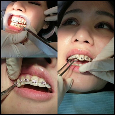 台北,牙齿矫正,牙医诊所,牙科矫正,戴牙套,装牙套,台北牙齿矫正,牙科